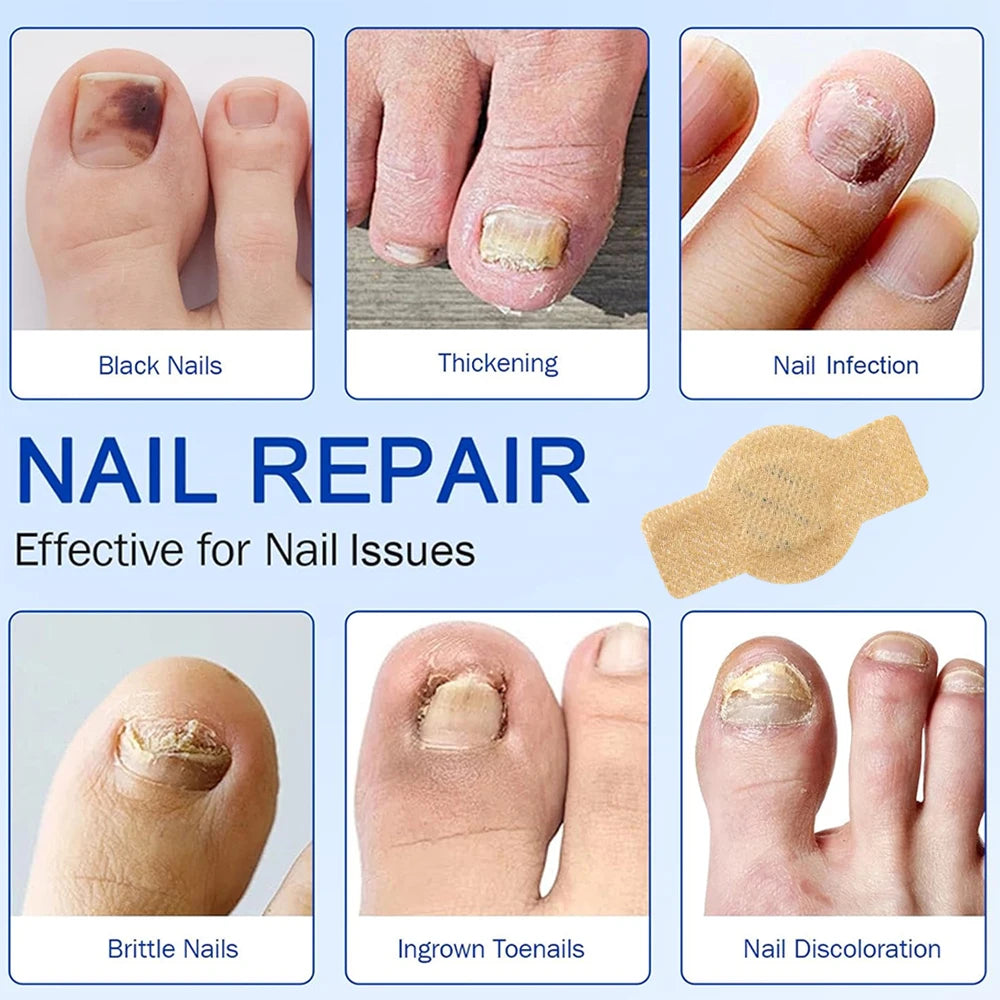 Nail Repair Patch Grey Fungal Nails Thickening Soft Paronychia Treatment Anti Infection Correction Sticker Ingrown Toenail Care