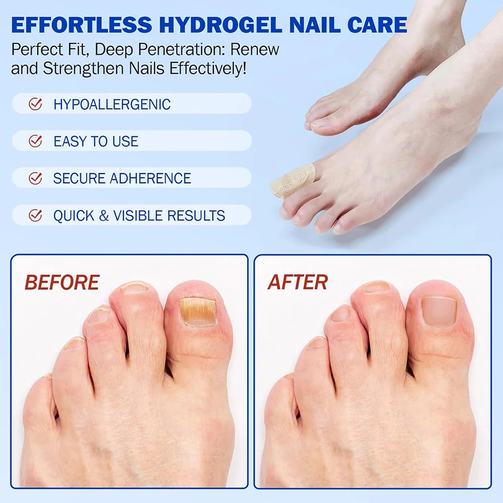 Nail Repair Patch Grey Fungal Nails Thickening Soft Paronychia Treatment Anti Infection Correction Sticker Ingrown Toenail Care